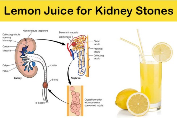 lemon-juice-for-kidney-stones_1.jpg